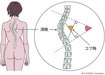 scoliosis_img002